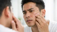 Kenali 9 jenis jerawat pada pria dan cara merawatnya tanpa bikin kulit makin rewel